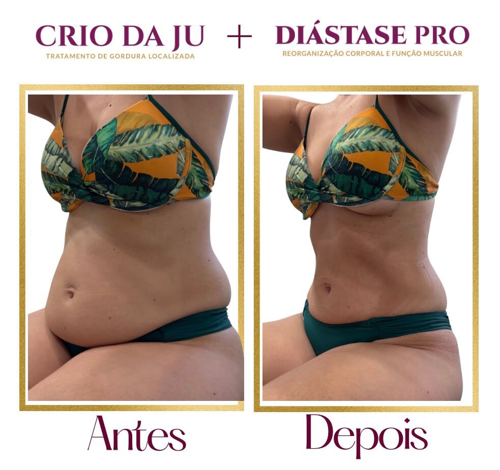 O Programa Diástase Pro foi desenvolvido para você que passou por uma gestação ou não - foto 1