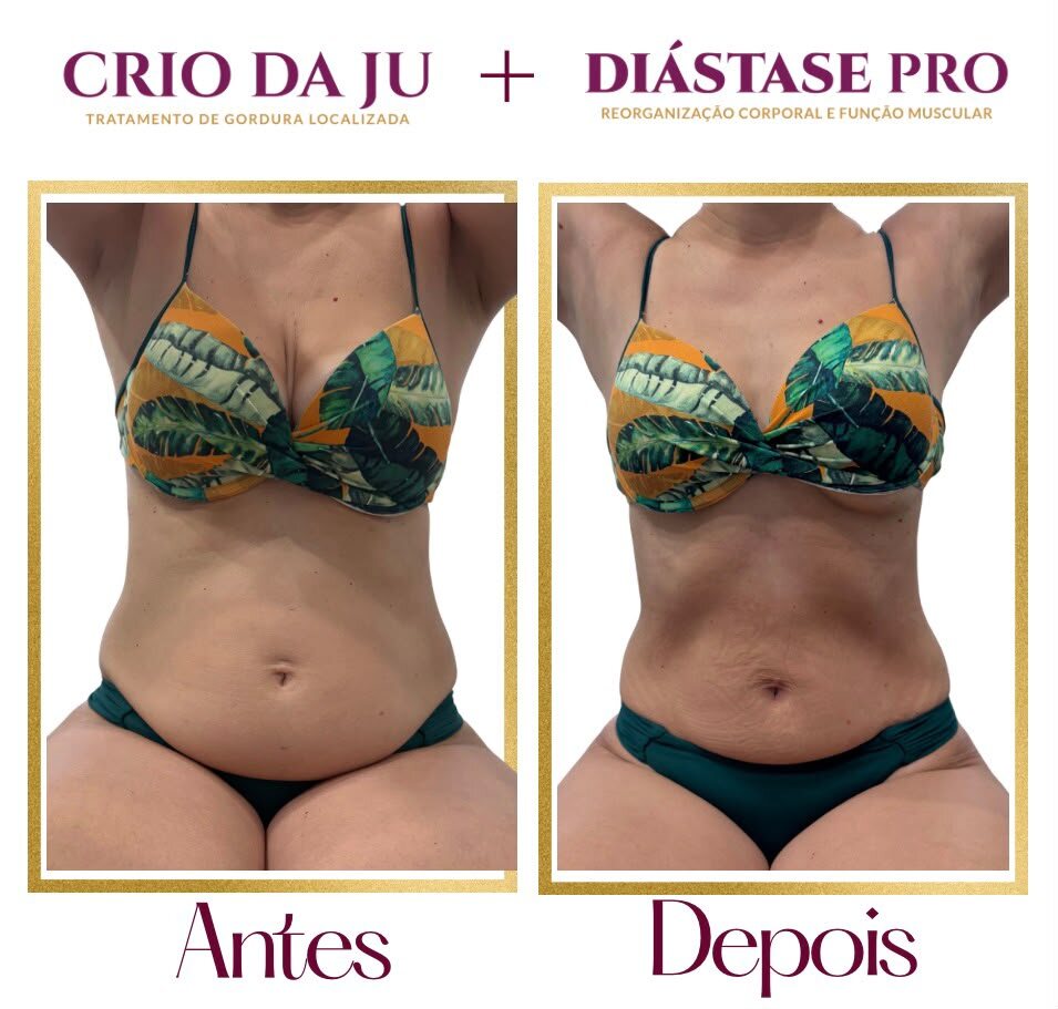 O Programa Diástase Pro foi desenvolvido para você que passou por uma gestação ou não - foto 2